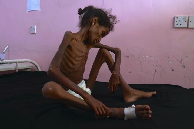 طفلة يمنية تحتضر بسبب الجوع